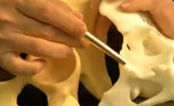 3D Printing Allows Surgery Rehearsal For Complex Orthopedic Procedures