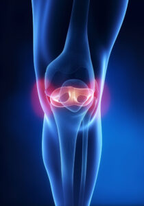 ACL Injury graphic