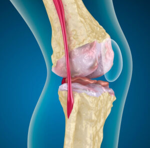 Knee pain graphic