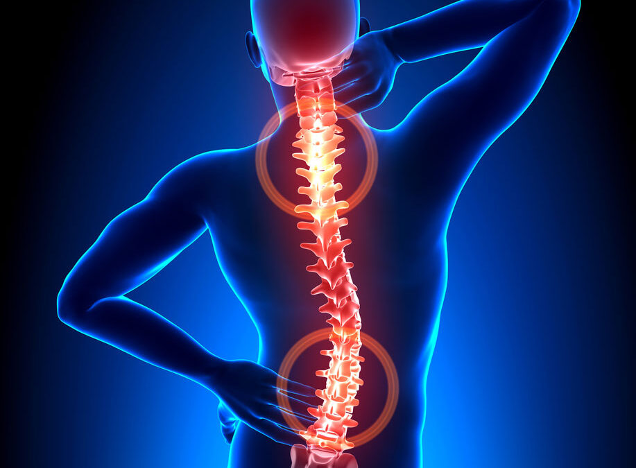 Spine image showing kyphoplasty